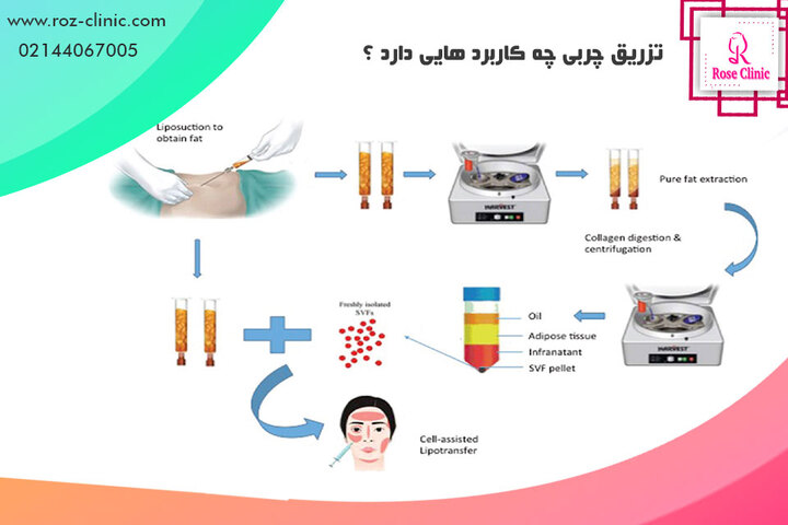 تزریق چربی چه کاربرد هایی دارد ؟ | کلینیک پوست و مو رز