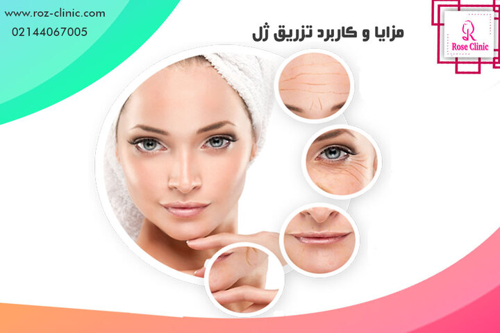 تزریق ژل - مزایا، عوارض و هزینه تزریق فیلر | کلینیک پوست و مو رز