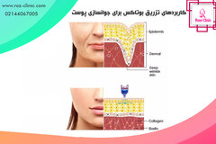 \u062a\u0632\u0631\u06cc\u0642 \u0628\u0648\u062a\u0627\u06a9\u0633 \u0628\u0631\u0627\u06cc \u062c\u0648\u0627\u0646\u0633\u0627\u0632\u06cc \u067e\u0648\u0633\u062a | \u06a9\u0644\u06cc\u0646\u06cc\u06a9 \u067e\u0648\u0633\u062a \u0648 \u0645\u0648 \u0631\u0632