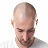 Dr. Arvind Poswal Best Hair Transplant in Delhi