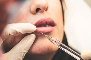 Understanding Dermal Fillers: Enhancing Beauty Safely