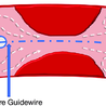 Fractional Flow Reserve Market 2022-27: Size, Share, Price Trends and Research Report