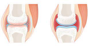 Arthritis and osteoarthritis: know the differences