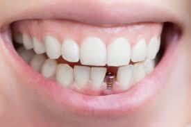 What Are The Recommendations For Patients Before And After Dental Implants?