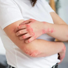 Treat fungal infection at Soul Derma Clinic in South Delhi
