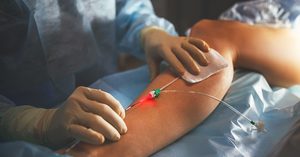 How To Know If You Require A Varicose Vein Treatment?
