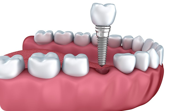 Ditch the Dentures! Why Dental Implants Are the Modern Solution