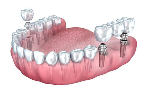 Dental Implants At Affordable Prices: AK Global Dental