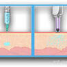 What will be the usage of Needleless Injection in the future?