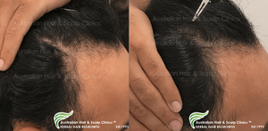 Discover Organic Care for Alopecia in Melbourne