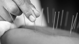 Discover Natural Healing with Acupuncture in Elsternwick
