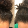 Effective Solutions for Female Hair Loss Treatment in Melbourne 