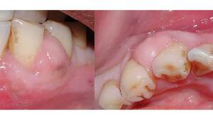 How Long Will Your Face Be Swollen And In Pain After A Root Canal?