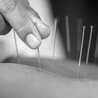 Discover Natural Healing with Acupuncture in Elsternwick