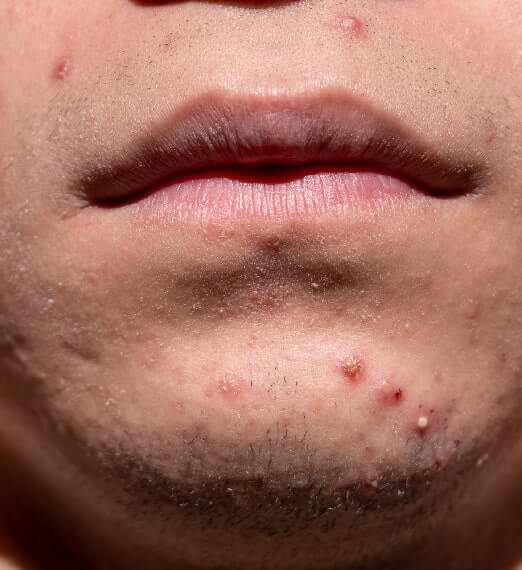 Acne Treatment by a Leading Skin Specialist at Charma Clinic