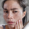 Get Melasma Treatment at Soul Derma