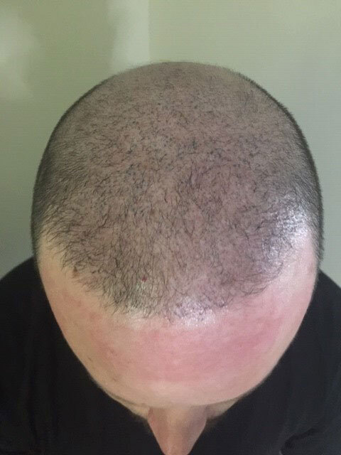 Restore Your Lost Self-Esteem with Scalp Micropigmentation