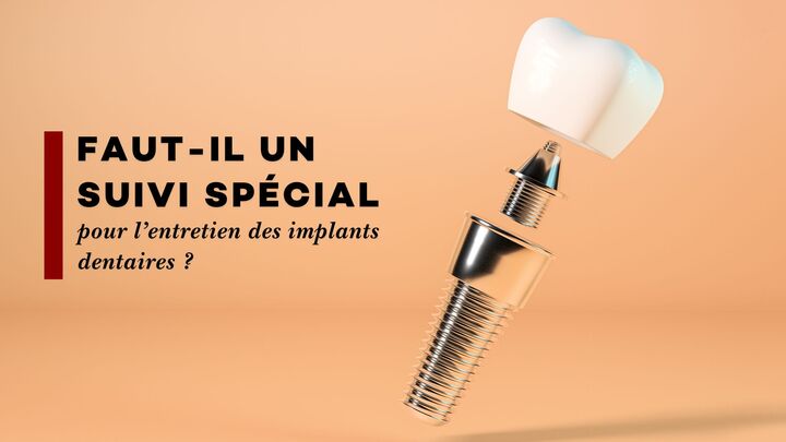 Faut-il un suivi spécial pour l’entretien des implants dentaires ?
