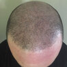 Restore Your Lost Self-Esteem with Scalp Micropigmentation