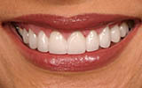 Smile Makeover 101: Combining Cosmetic Dentistry Treatments for Stunning Results