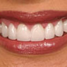 Smile Makeover 101: Combining Cosmetic Dentistry Treatments for Stunning Results