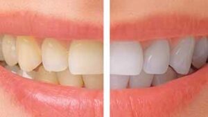 C\u00f3mo los implantes All-on-4 pueden restaurar su sonrisa