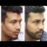 Facial Hair Transplant In Rancho Mirage