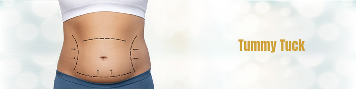 Understanding Tummy Tuck Surgery: What You Need to Know