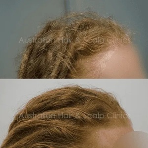 Hair Loss Treatment in Brisbane That offer Healthier Hair 