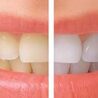 C\u00f3mo los implantes All-on-4 pueden restaurar su sonrisa