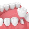 What is All-on-4 Dental Implant Procedure?