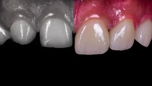 Avant \/ apr\u00e8s facettes dentaires \u00e0 Gen\u00e8ve : effet durable ou non ?