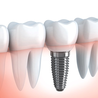 The Ultimate Guide to Dental Implants: What You Need to Know