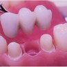 What Is the Most Used Type of Dental Implant?