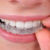 What Are Dental Veneers?