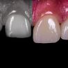 Avant \/ apr\u00e8s facettes dentaires \u00e0 Gen\u00e8ve : effet durable ou non ?