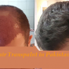 The Success Rate of Hair Transplant Surgery 