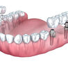 An Affordable Dental Implants in Gurgaon: AK Global Dental