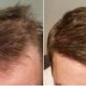 Permanent Hair Restoration Surgery Treatment 