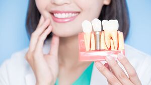 Tout savoir sur les implants dentaires et leur entretien
