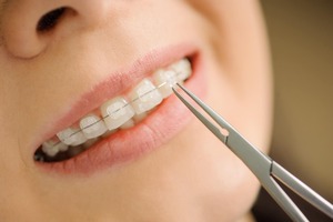 What Do You Need To Consider When Picking Braces Colors As An Adult?