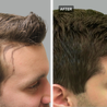 Hair Transplantation Is The Best Hair Treatment