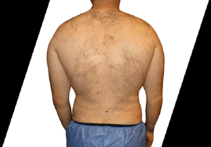 \&quot;How Can I Remove Stubborn Fat Near Me?