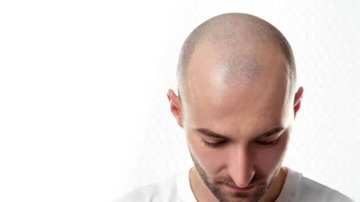 Get FUE Hair Transplant By an Expert Surgeon