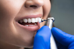 How Long Does Dental Implant Treatment Take?