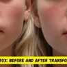 Botox Chin Before and After, Expert Insights
