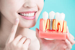 United States Dental Implants Market Size, Share, Growth, Trends and Forecast 2022-2027