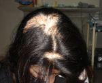 Hair Transplant Treatment for Alopecia 