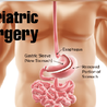 What Lifestyle Changes Are Required After Bariatric Surgery?