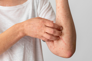 Lupus and the Skin: Understanding Its Impact and Variants\u00a0